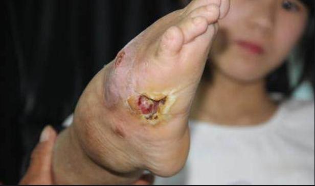 先天性马蹄足,先天性马蹄足矫形方法