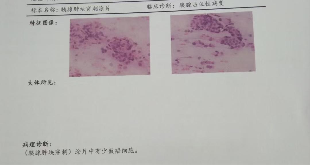 不做活检能确诊胰腺癌吗,癌中之王有多可怕