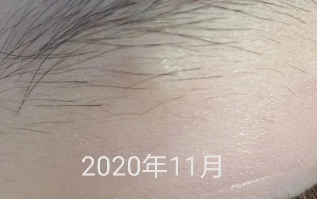 孩子头部皮脂腺囊肿能保守治疗吗,孩子面部皮脂腺囊肿