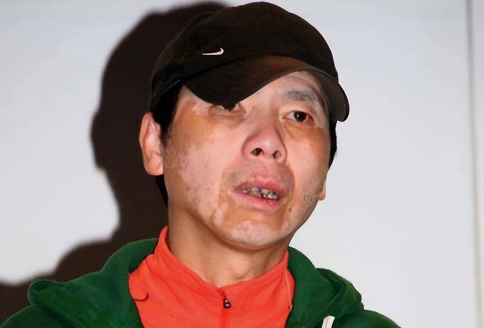 冯小刚近照曝光白癜风明显,冯小刚图片白癜风