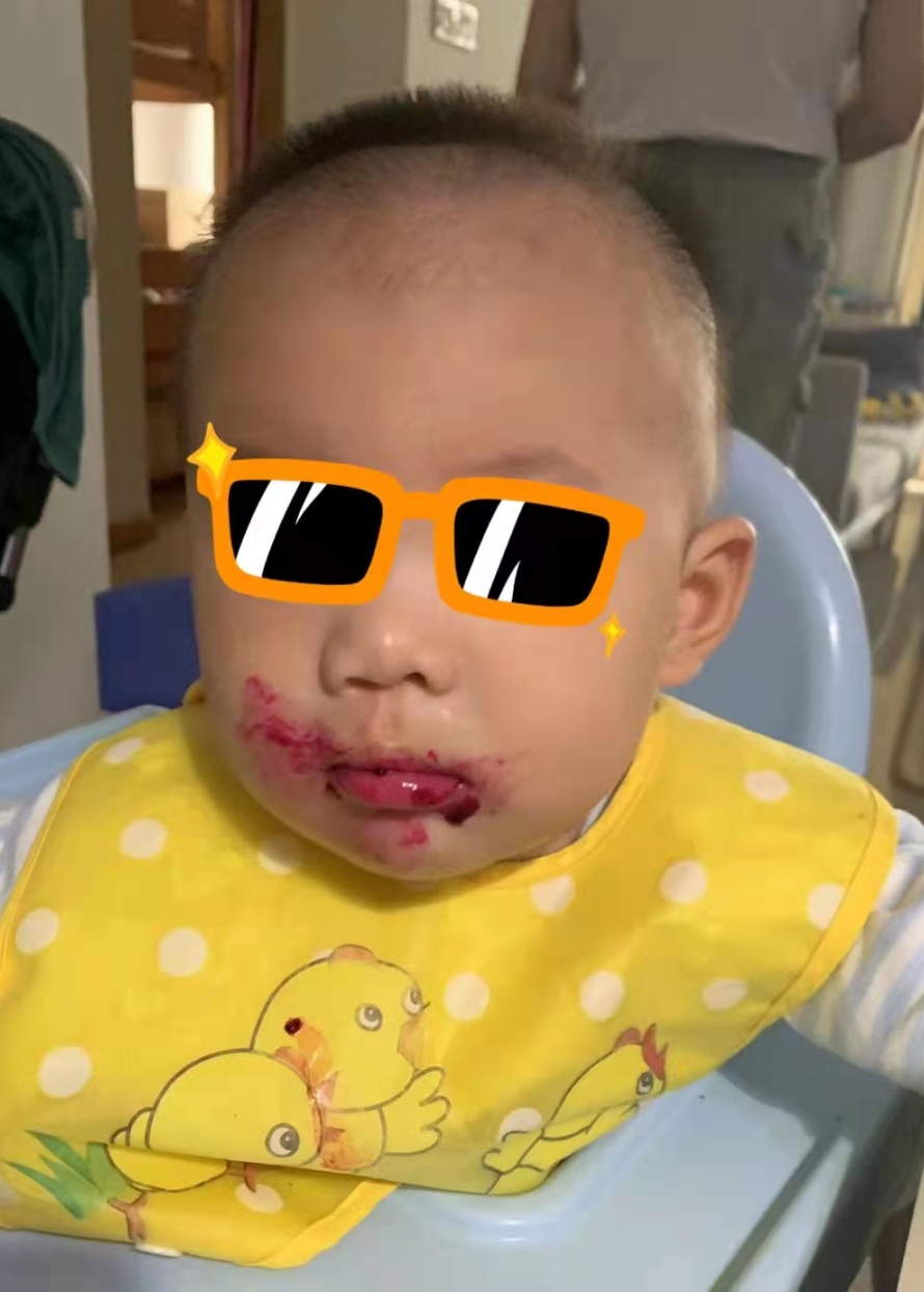 宝宝是一只“小兔子”，还没长牙就要开始正畸了