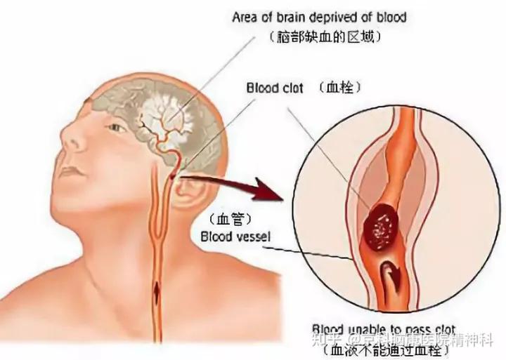 脑梗后康复需要多少钱,脑梗中风能治好吗多少钱