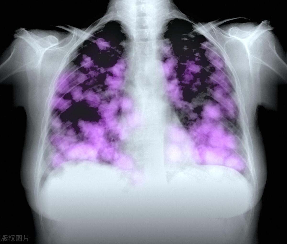 得了肺癌还能活多久取决于3点,人得了肺癌大概还能活多久
