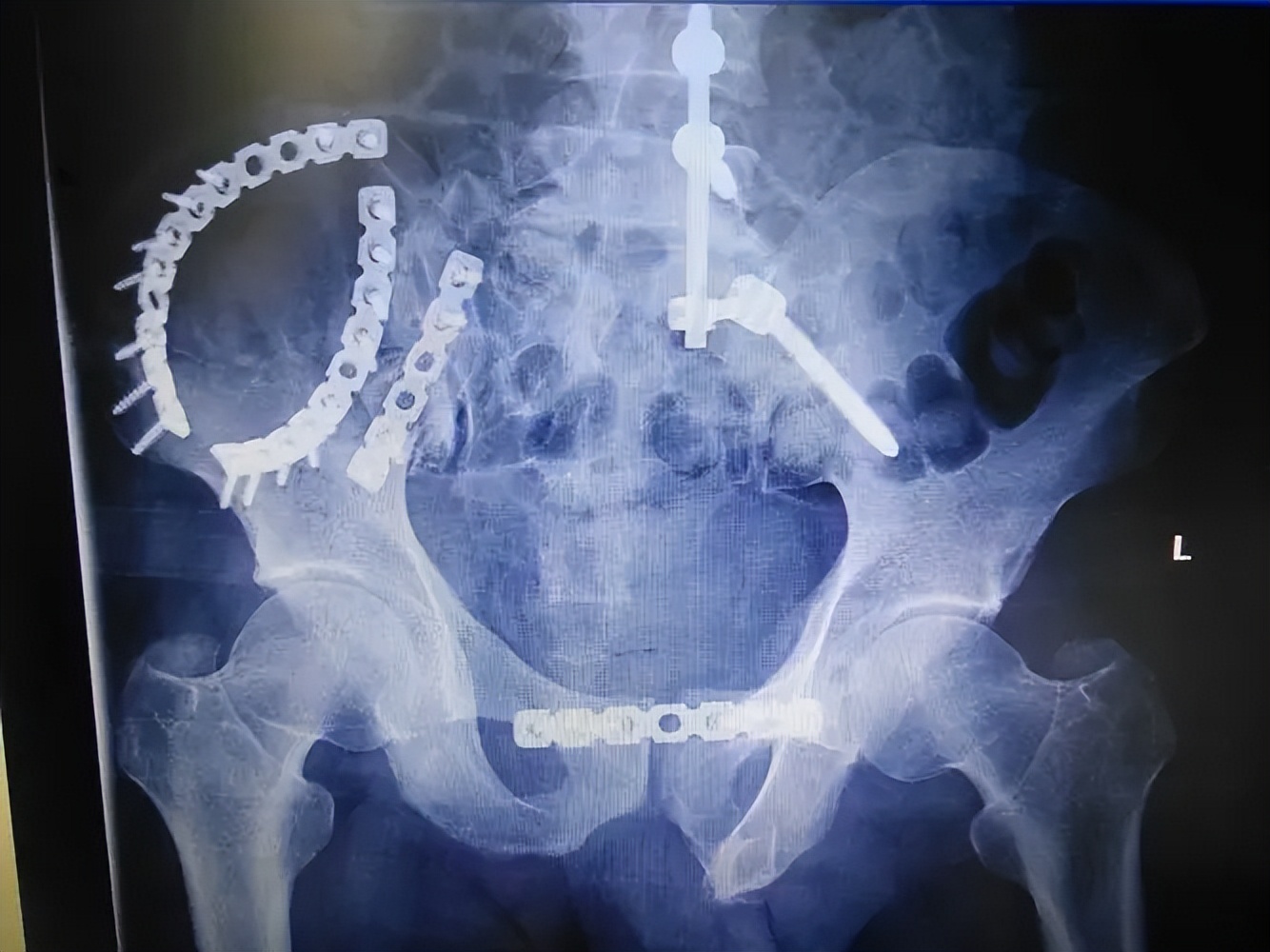 骨盆后环损伤后，新型螺钉的不同内固方法各有何优势？哪种方法好