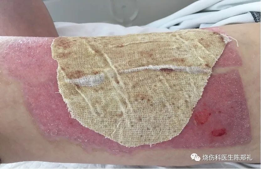 创面外用药物及敷料的使用策略及理论依据