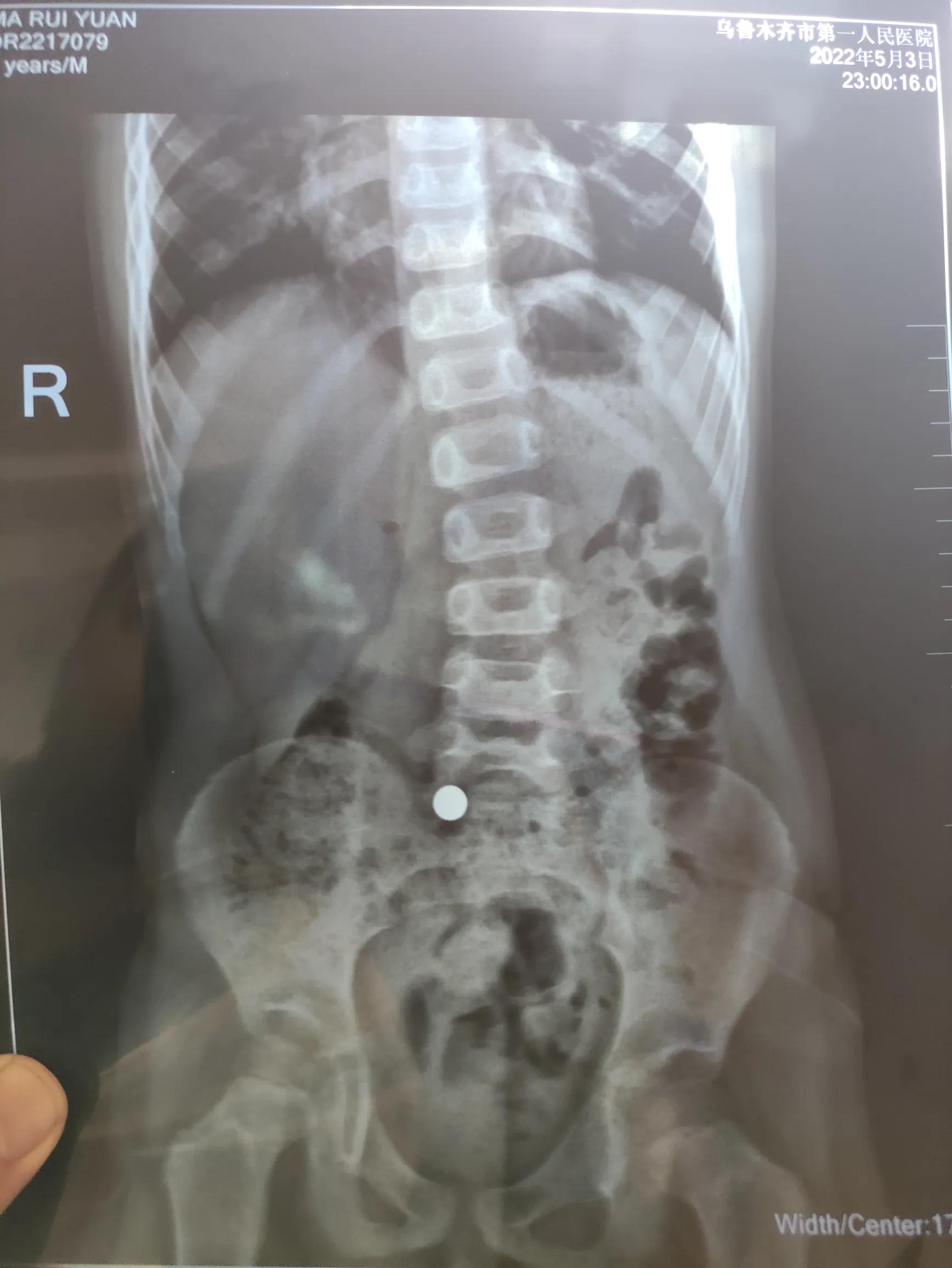 小孩误食螺丝钉有什么反应,孩子误食塑料珠