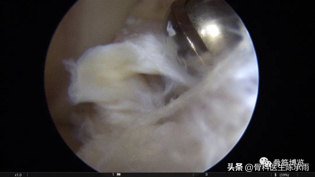 内侧半月板前角囊肿,关节镜下内侧半月板部分切除术