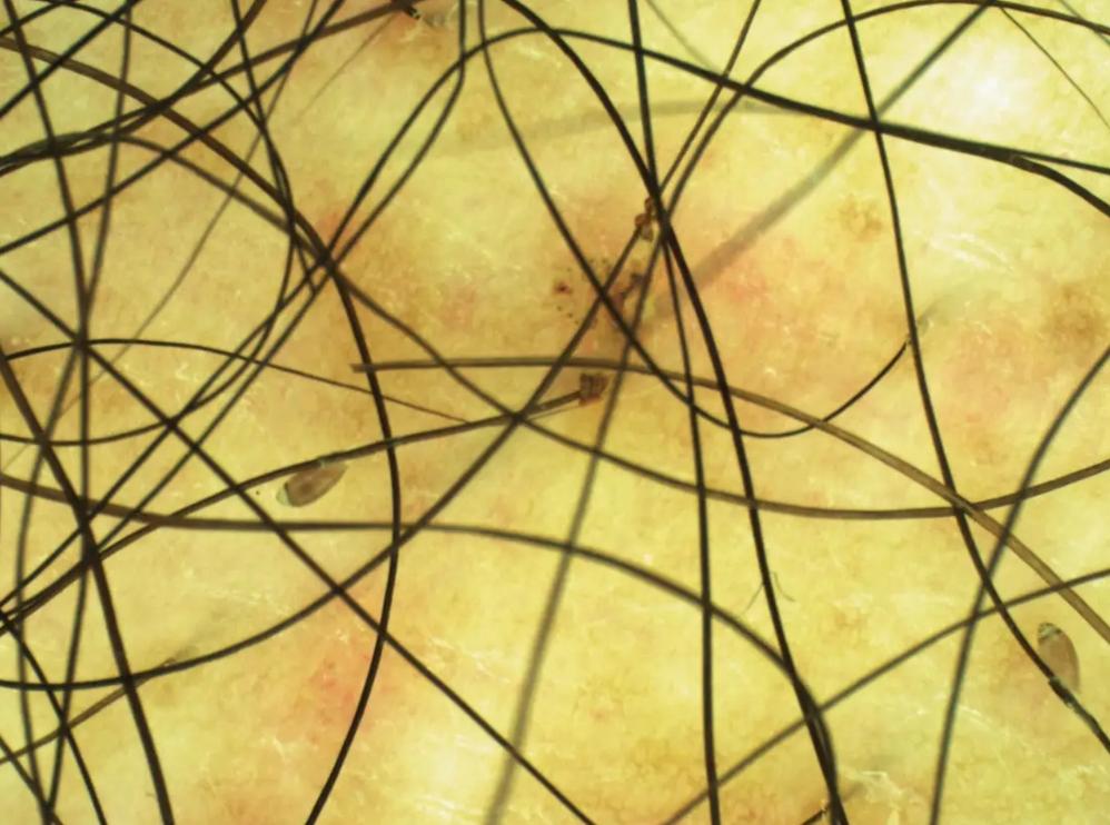 把阴虱用镊子找出来可以吗,阴虱是怎么通过性传播的