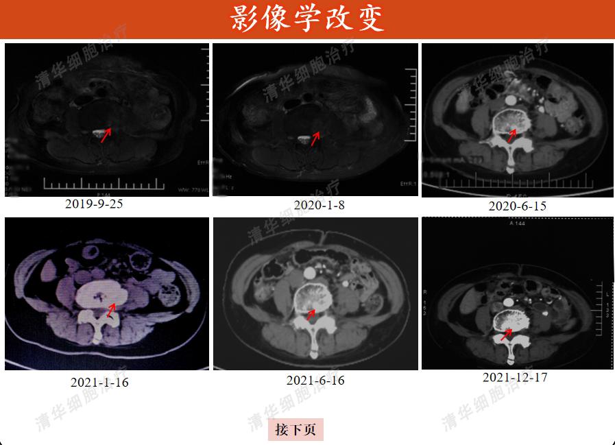 胰腺癌有突破10年的吗,一旦确诊胰腺癌还能活多久