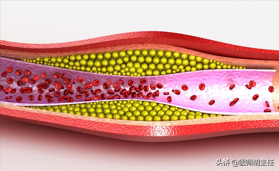 年轻人斑块是否能逆转,55岁大叔斑块消失