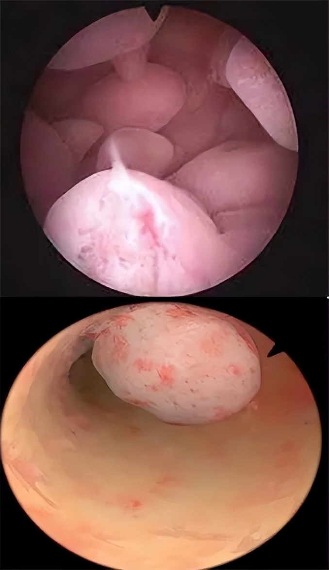 子宫里长了一堆肉球？一直漫不经心的我被吓懵