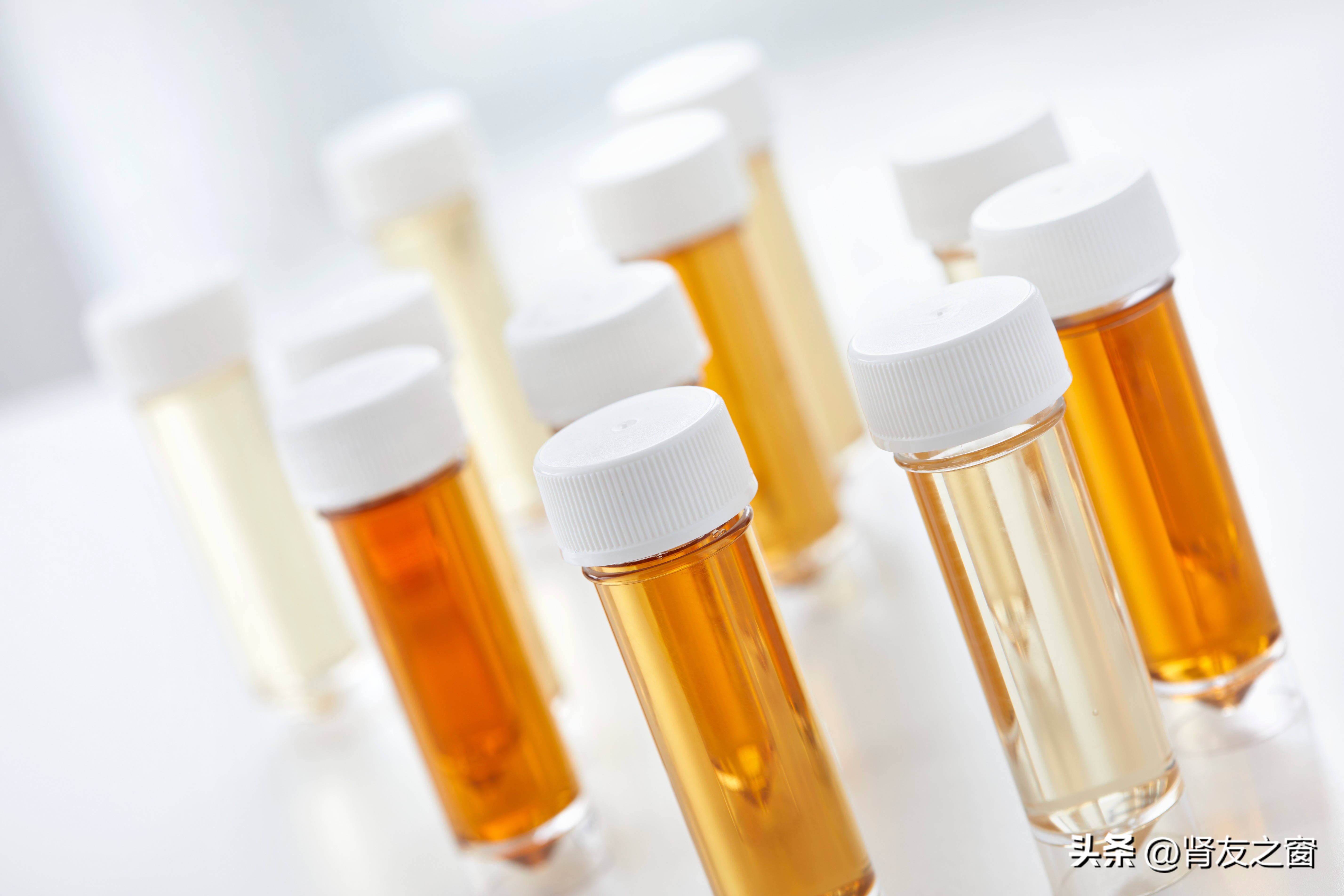 当2型糖尿病遇上尿路感染（二）