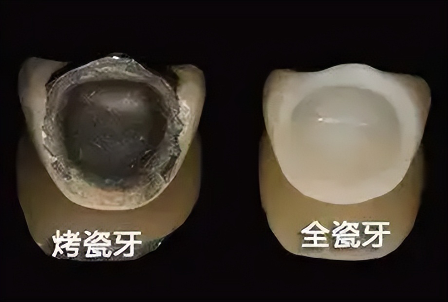 烤瓷牙和全瓷牙价格,烤瓷牙与全瓷牙价格对比