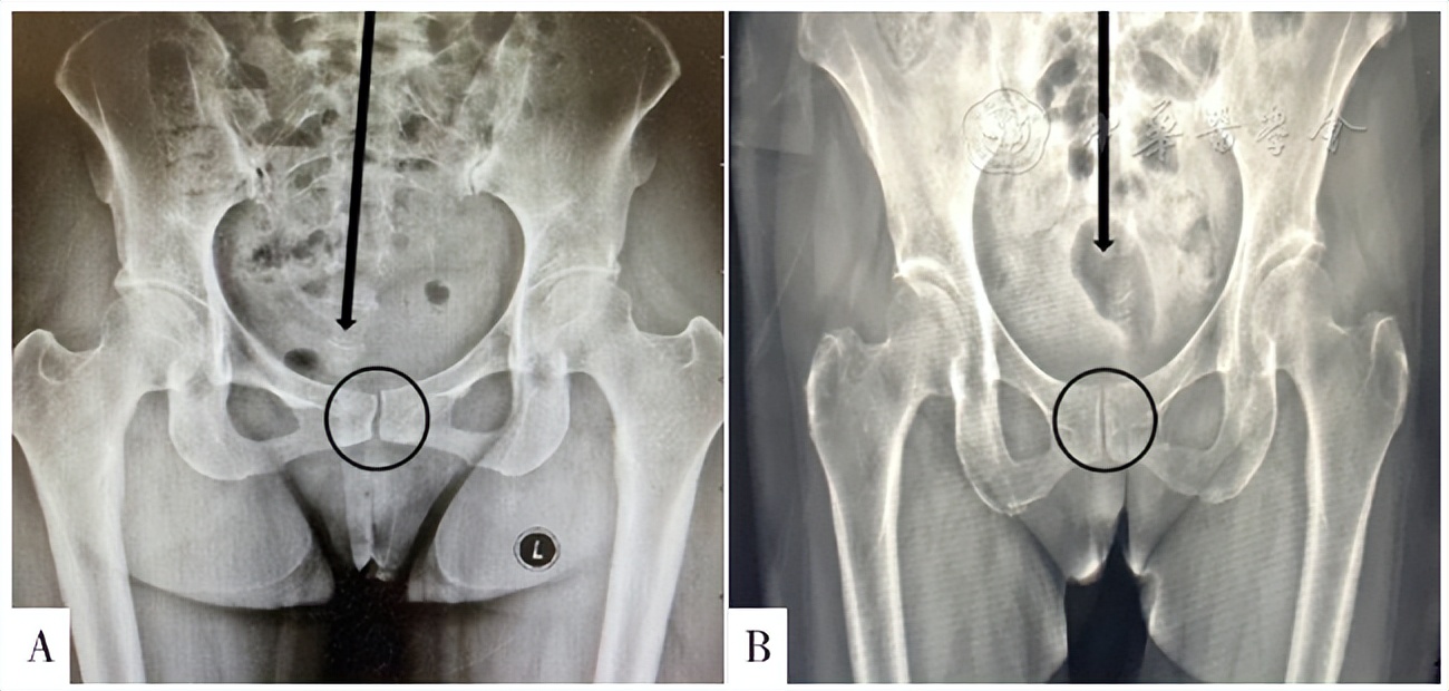 姿势解密技术治疗持续性生殖器官兴奋紊乱/生殖器官-骨盆感觉障碍综合征一例并文献复习