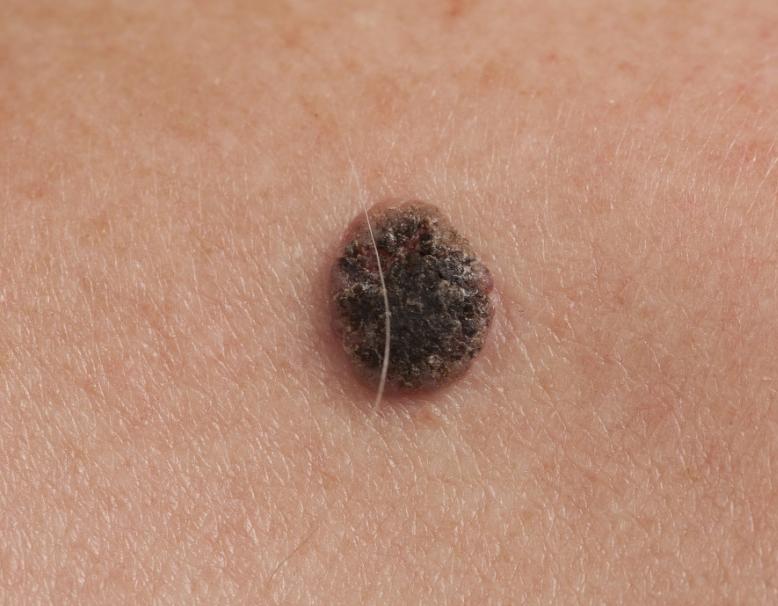 警惕这些痣可能会成瘤,哪些地方有痣代表得癌症了