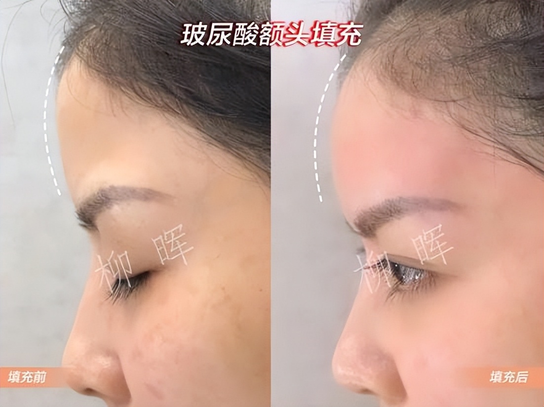 玻尿酸打额头的方法,玻尿酸打鼻子山根变宽真实案例
