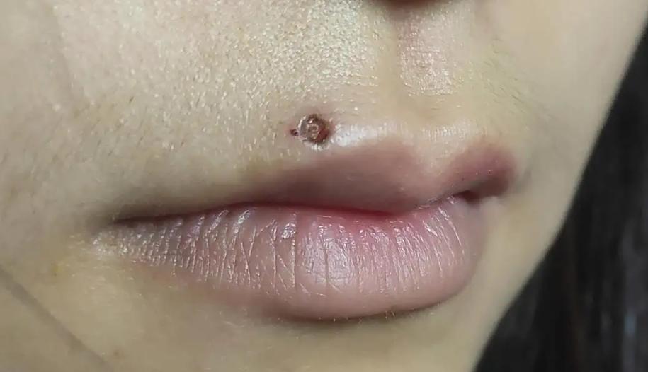 人身上有瘊子怎么处理,身上五种疣可能是hpv感染