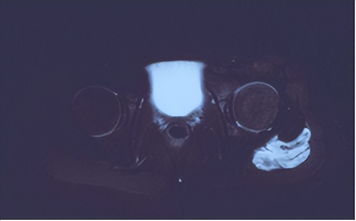下肢肌间静脉畸形治疗案例,臀部静脉畸形怎么治疗比较好