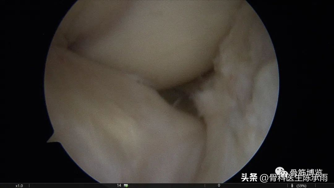 内侧半月板前角囊肿,关节镜下内侧半月板部分切除术