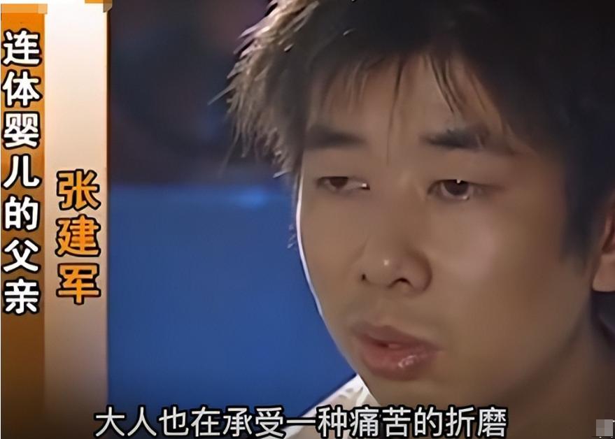 连体婴姐妹18年成功分离,连体婴姐妹成功分离后续