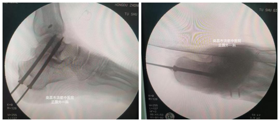脚踝扭伤腓骨肌腱脱位的症状,踝关节外侧韧带损伤发病原因