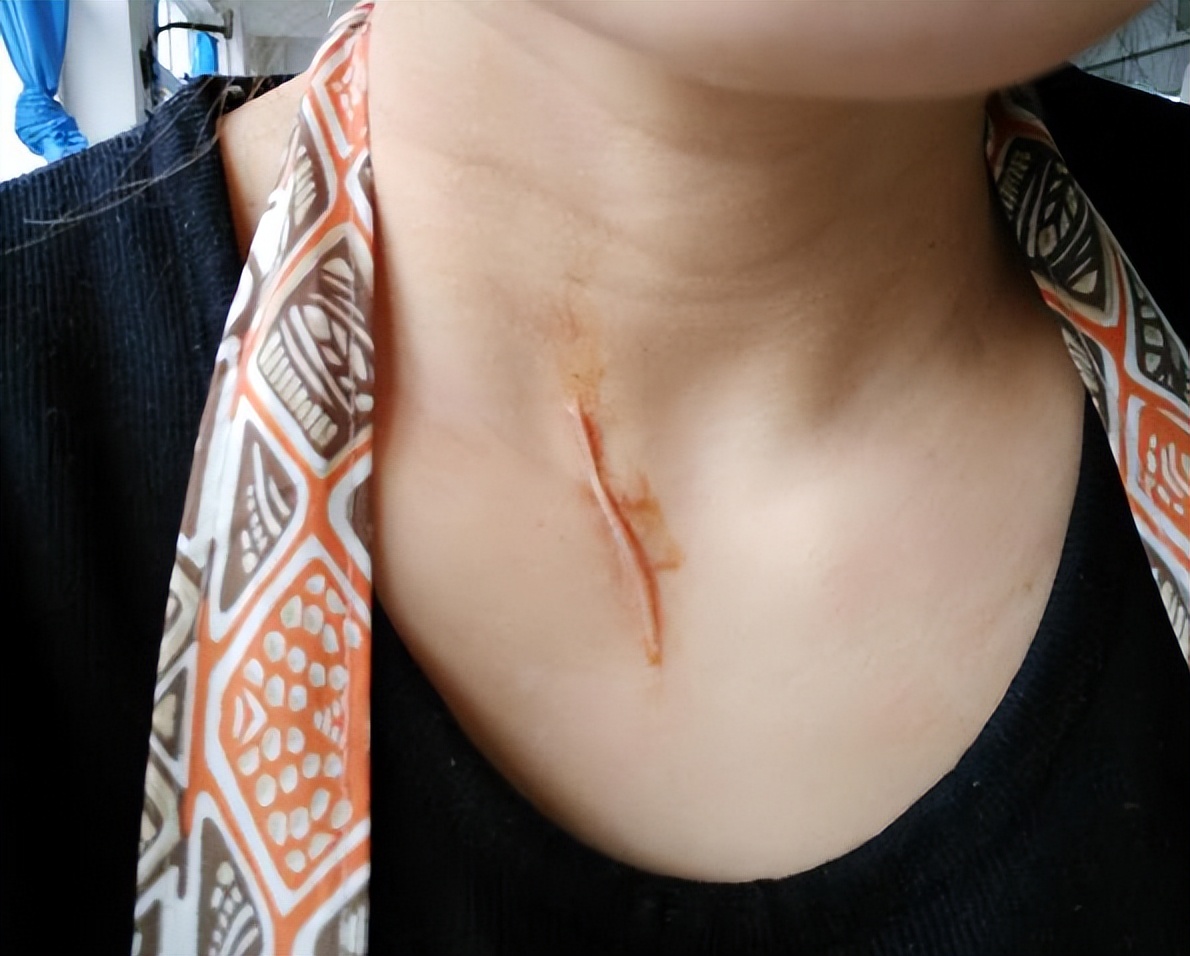 郑州市第二中医院疤痕科,郑州市第二中医院治疗疤痕靠谱吗