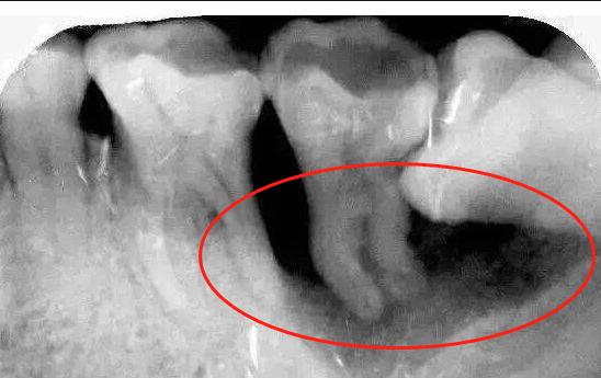 牙根腐烂要怎么治疗才可以恢复,牙根腐烂怎么治疗最快