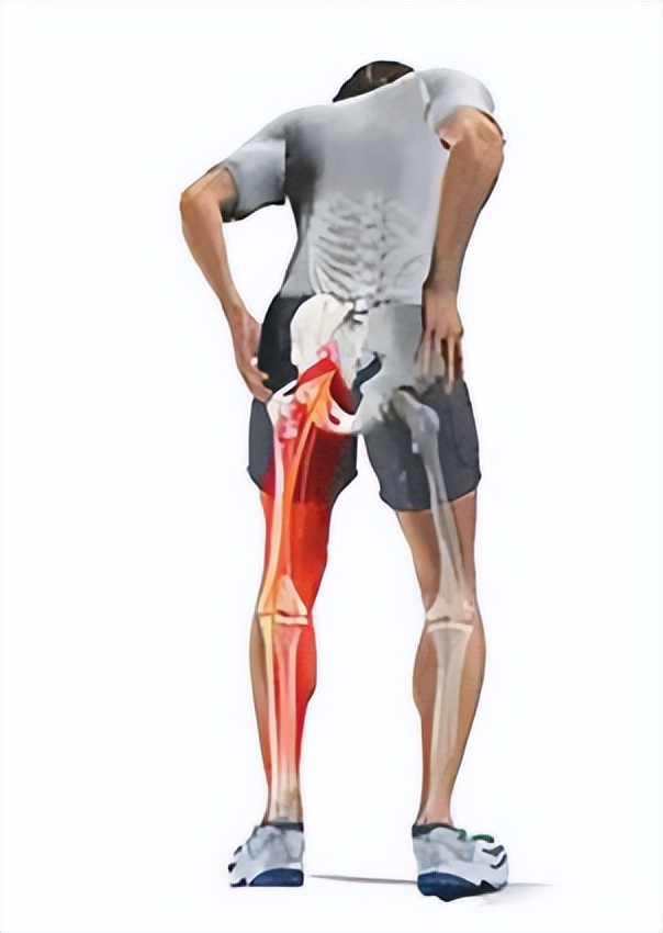 臀部痛和小腿痛怎么回事,臀部痛和大腿痛是股骨头坏死吗