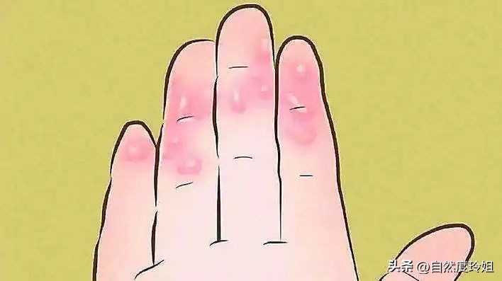 夏天手脚长小水泡很痒是什么原因,夏天长痒痒的水泡