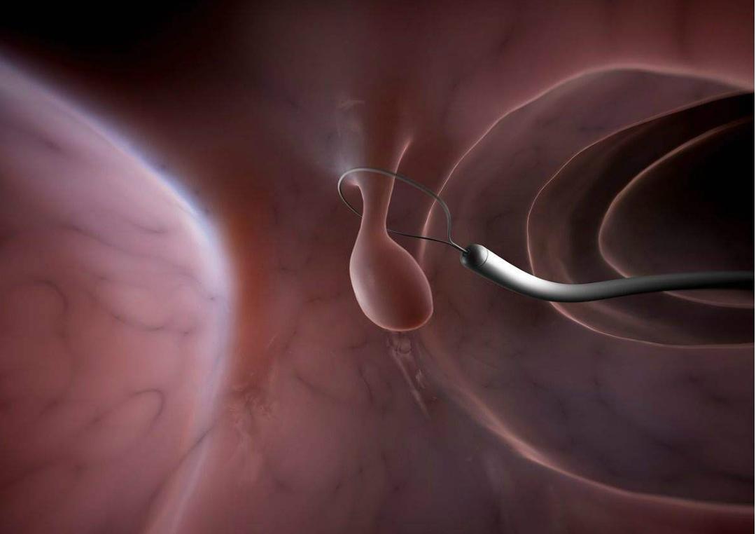 男医生给女朋友做肠镜,有男医生给女性做肠镜吗