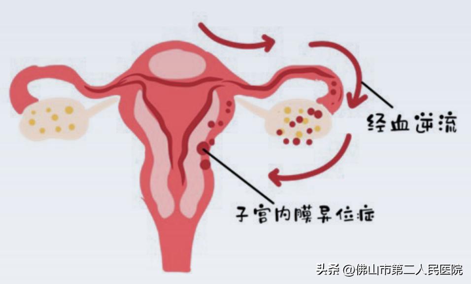 痛经子宫内膜异位症怎么治,痛经不孕子宫内膜异位