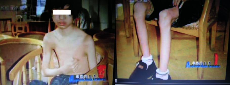 沈华浩胸闷变异性哮喘,胸闷变异性哮喘治疗的最佳方法