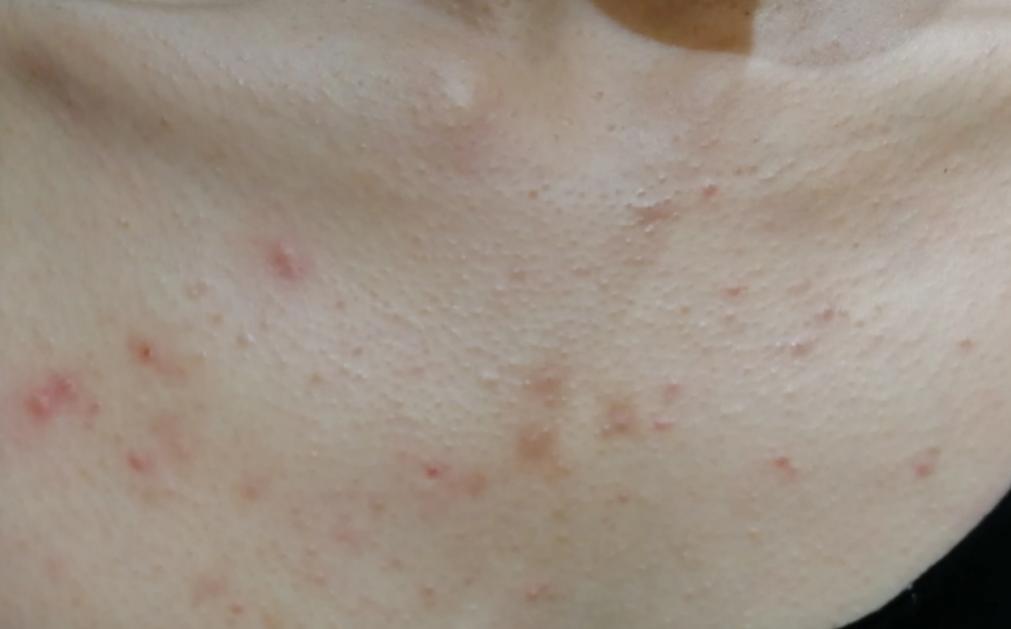 胃火肺火的症状有哪些表现,有胃火和肺火的症状