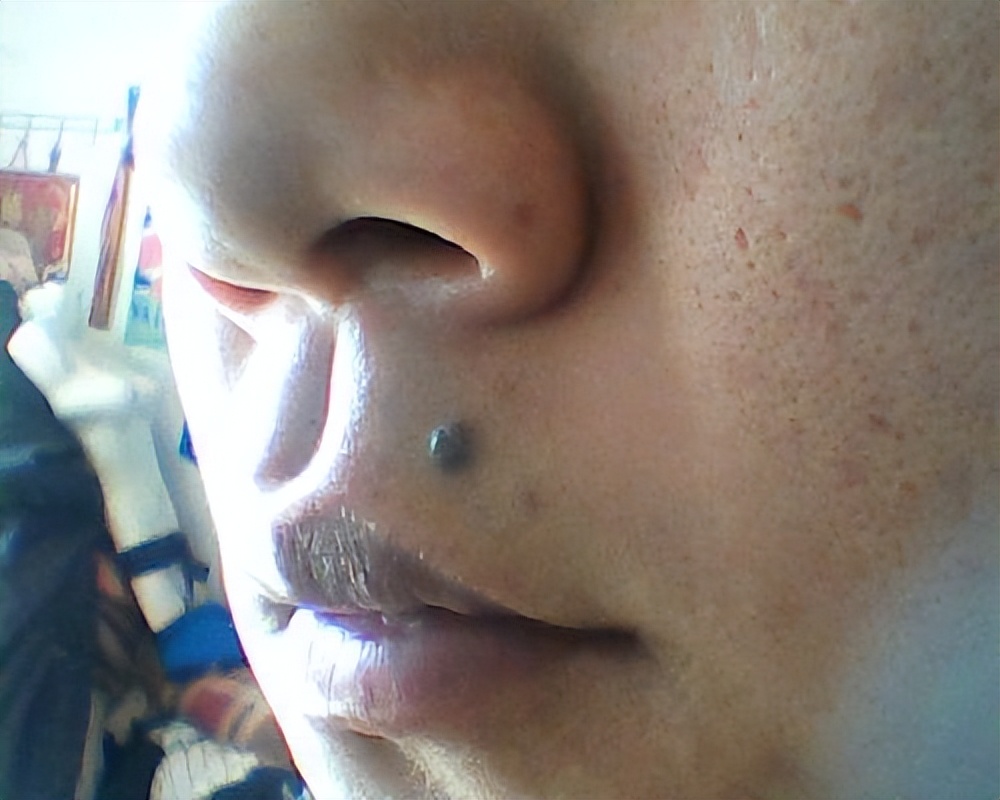 身体部位有黑痣和红痣是什么,痣黑如漆与深黑死痣区别