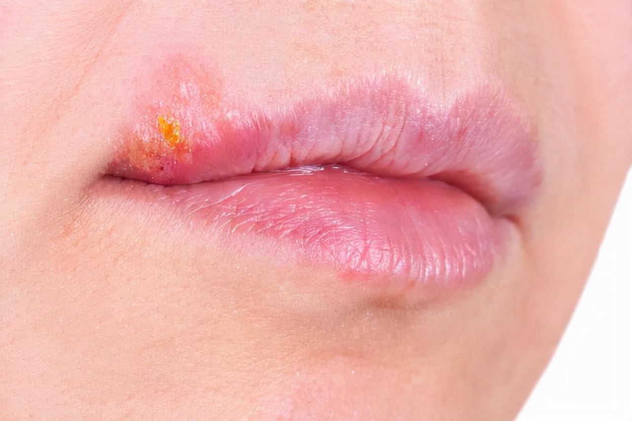 嘴巴周围时不时出现“几个水泡”，提醒：这不是“上火”，会传染