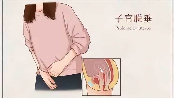 子宫脱垂有哪些病症,子宫脱垂属于重大疾病么