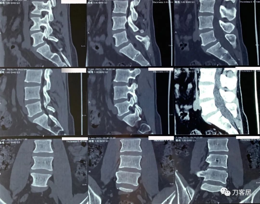 新冠病毒感染后两肋疼痛,新冠病毒感染后后背疼怎么回事
