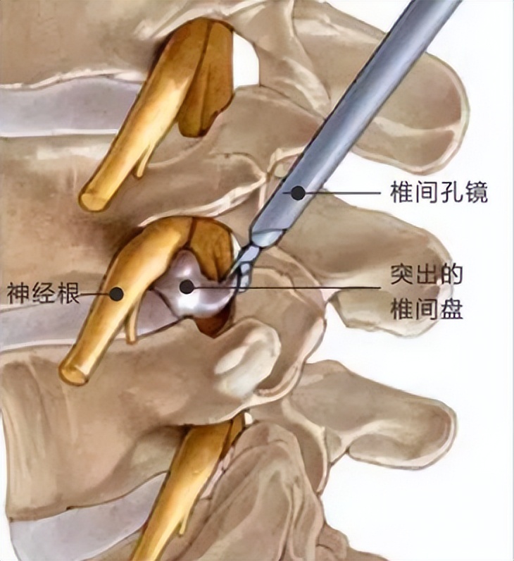 腰椎间盘4-5节突出最好治疗方法,预防腰椎间盘问题
