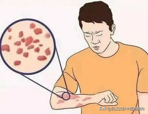 身上超痒的红色小鼓包是什么,身上起红色一片很痒
