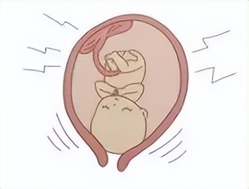 子宫收缩剧烈会羊水破裂吗,子宫小会导致羊水早破吗