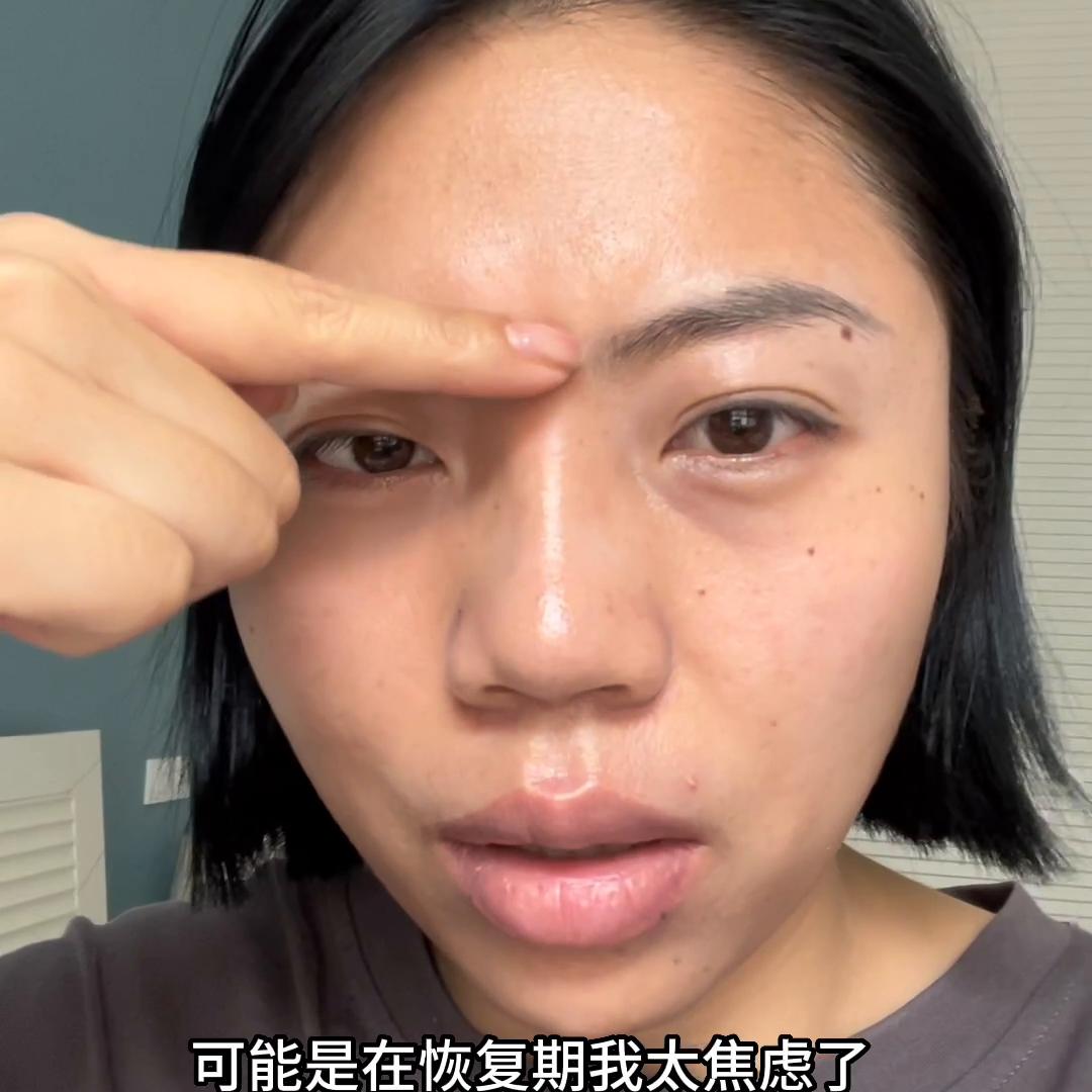 鼻子术后五个月了山根还是高,做完鼻子恢复后发现山根歪的