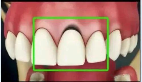 范冰冰做烤瓷牙前后照,范冰冰做的牙贴片还是烤瓷牙