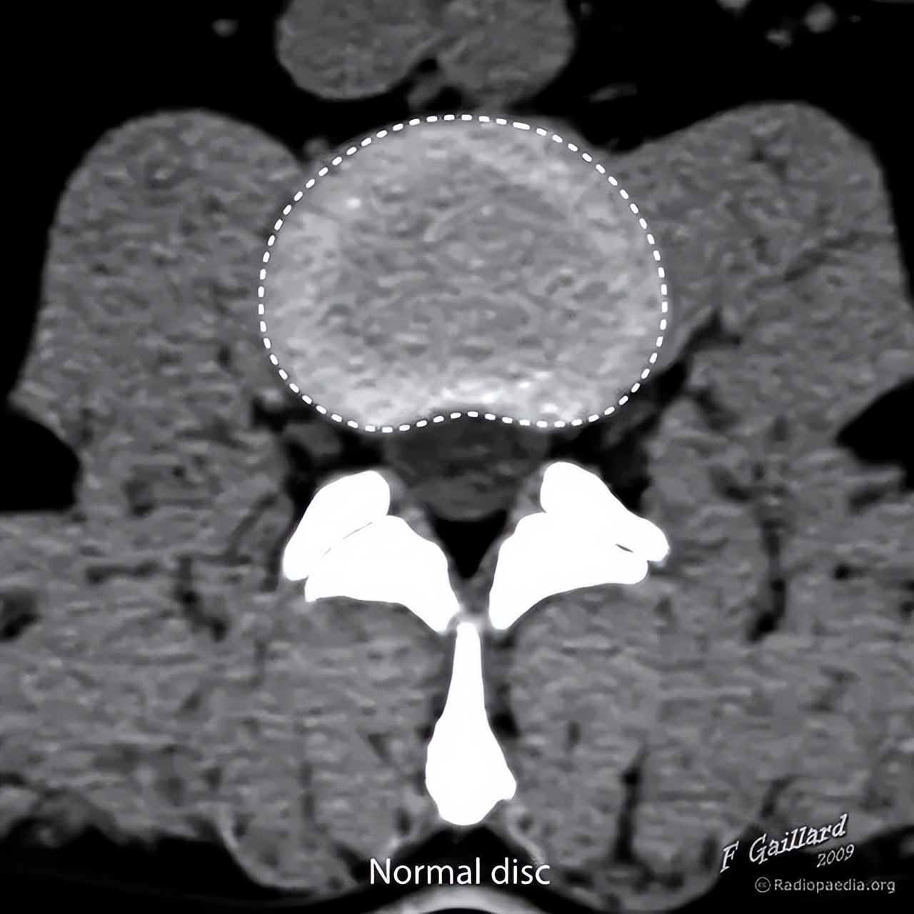 椎间盘突出膨出脱出如何治疗最好,椎间盘突出图怎么看