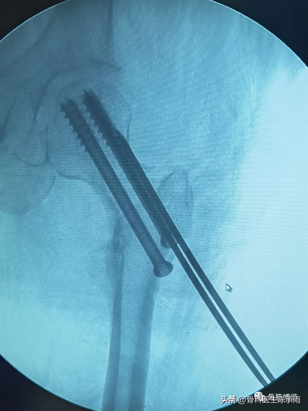 股骨颈闭合复位内固定术后护理,股骨颈骨折闭合复位的技巧