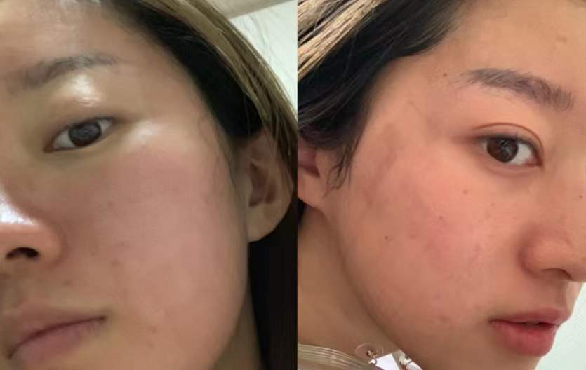 缩小毛孔做水光还是点阵,小姐姐直播说收缩毛孔