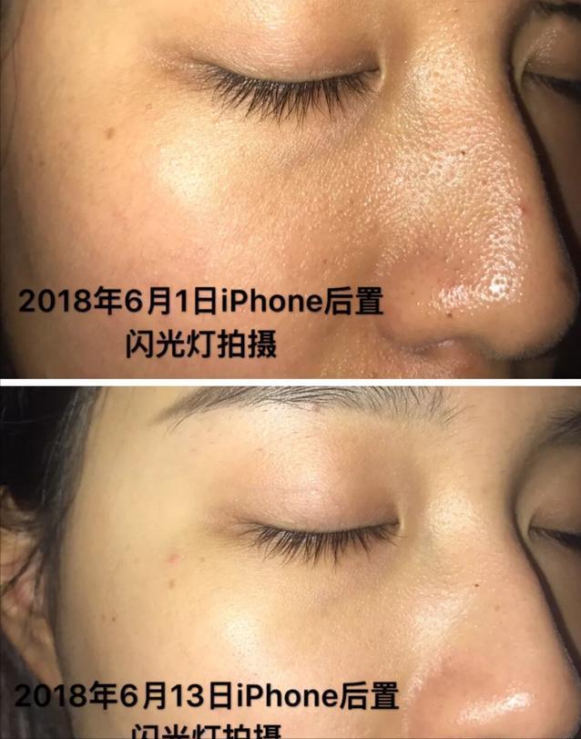 泰国美白针真实事件,女子连续打6年美白针