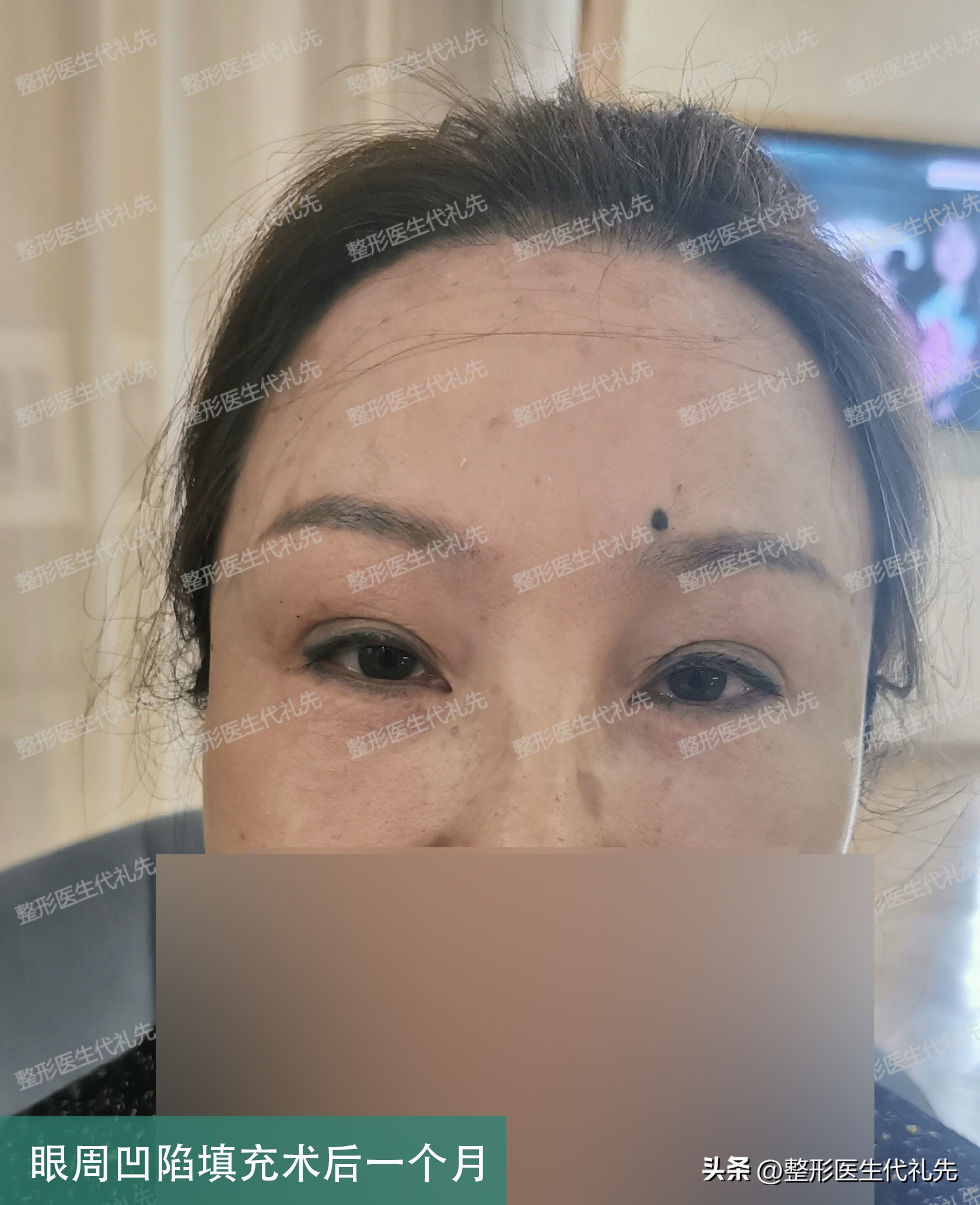 眼窝凹陷睡觉可以恢复吗,长时间熬夜下眼窝凹陷可以恢复吗