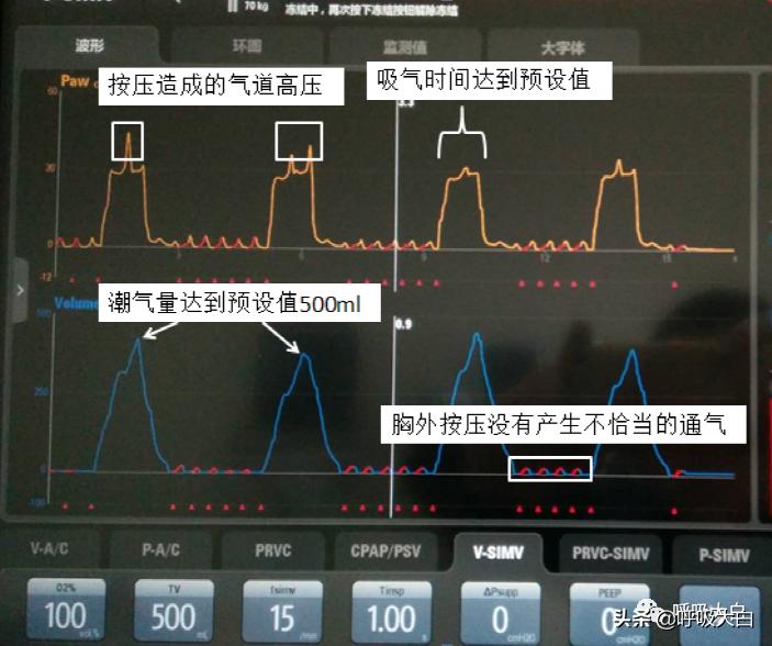 呼吸机：报警设置、心脏按压时的呼吸机设置