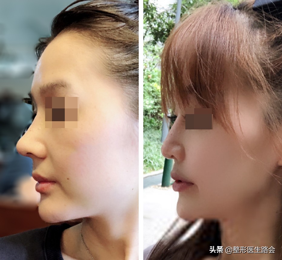 为什么隆鼻很久了鼻子还会歪,隆鼻了怎么确定鼻型歪不歪