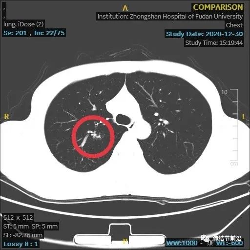 炎症引起的肺实性结节生长速度,肺部结节影像学读片讲解视频
